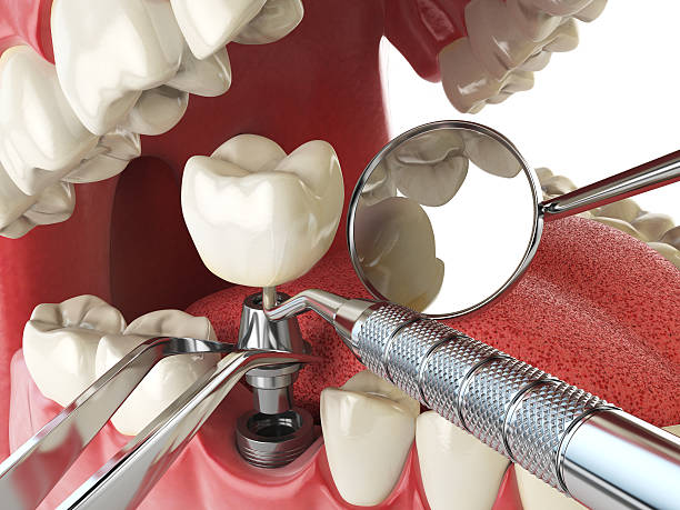 Best Broken or Cracked Tooth Emergency Dentist in Grace, ID